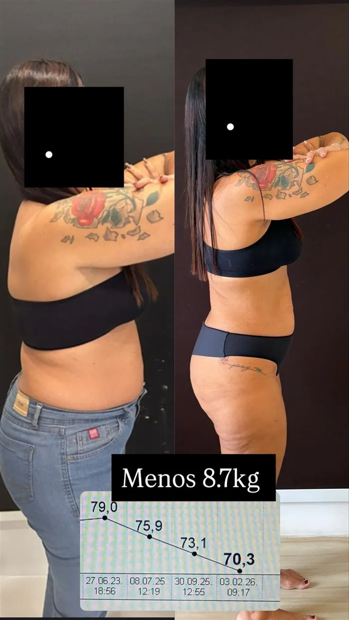 Antes e depois de paciente da Dra. Raquel, 8,7 kg a menos