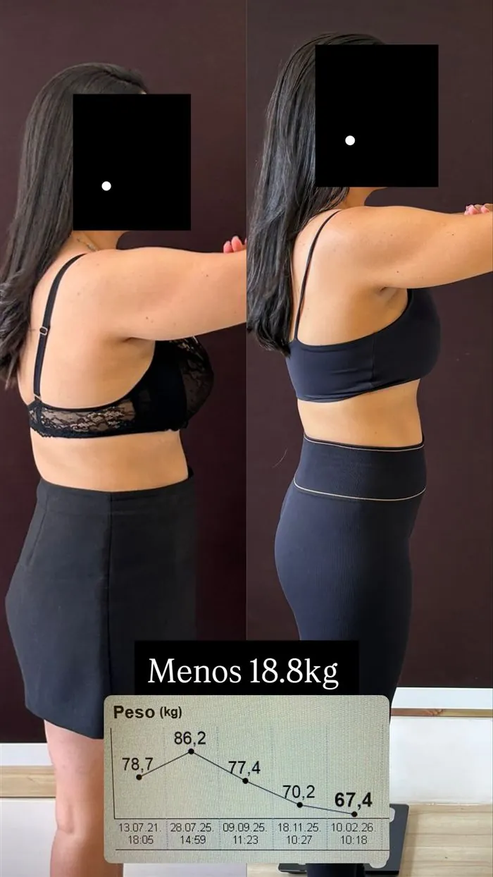 Antes e depois de paciente da Dra. Raquel, 18,8 kg a menos