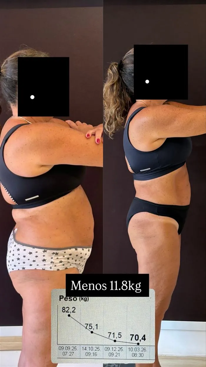 Antes e depois de paciente da Dra. Raquel, 11,8 kg a menos