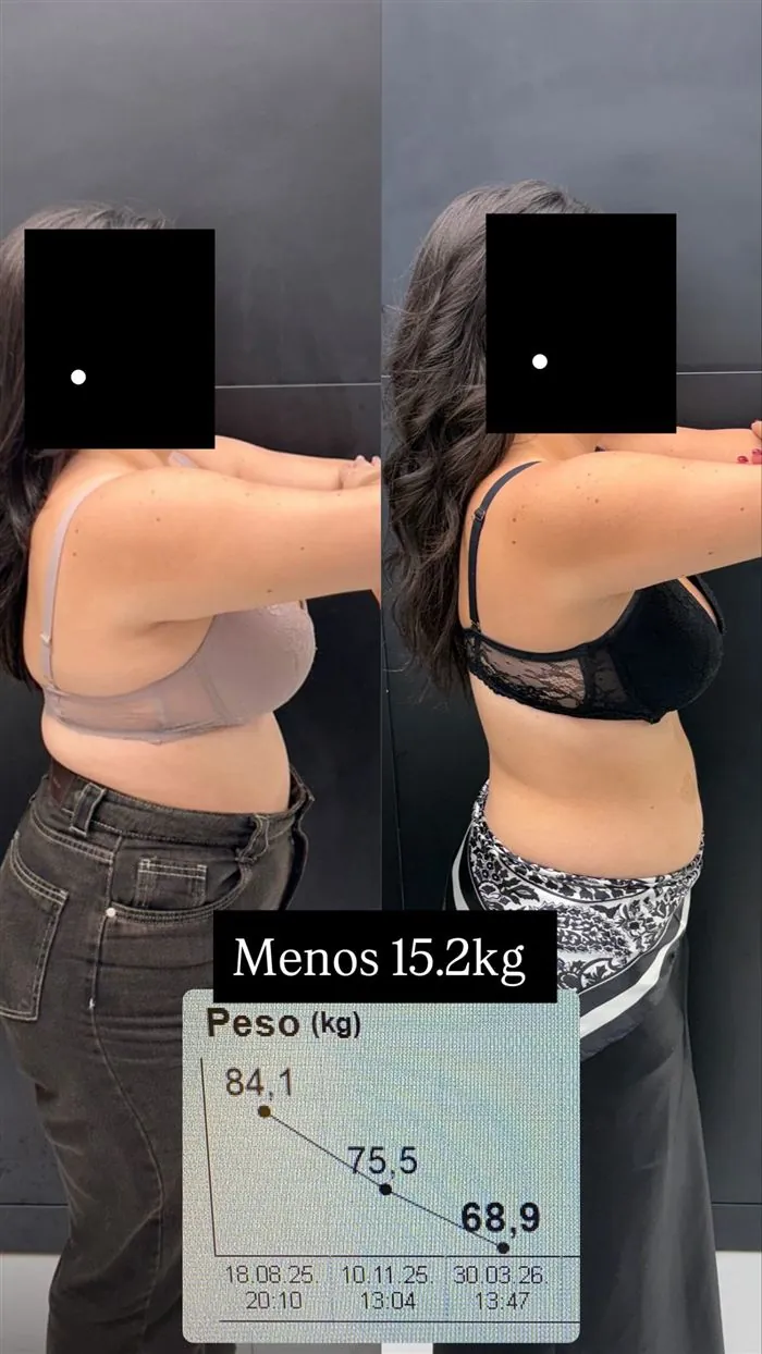 Antes e depois de paciente da Dra. Raquel, 15,2 kg a menos