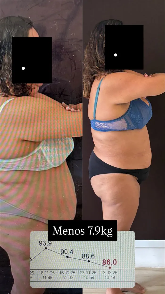 Antes e depois de paciente da Dra. Raquel, 7,9 kg a menos