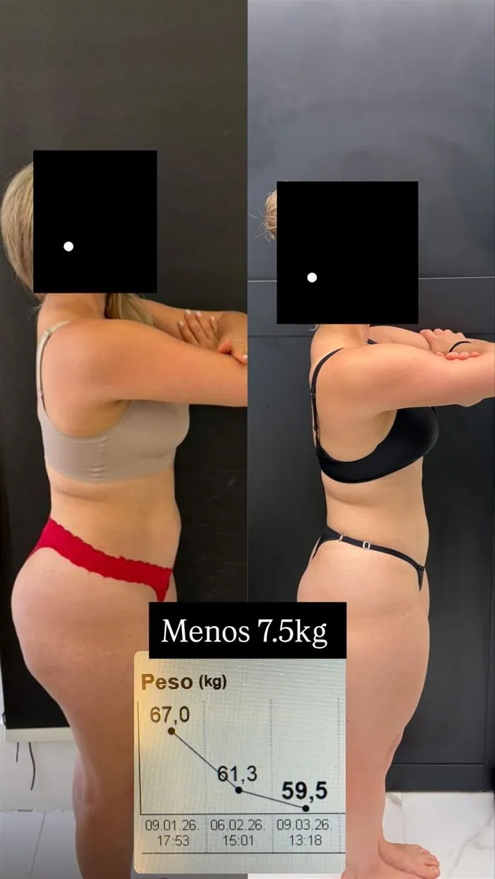 Antes e depois de paciente da Dra. Raquel, 7,5 kg a menos
