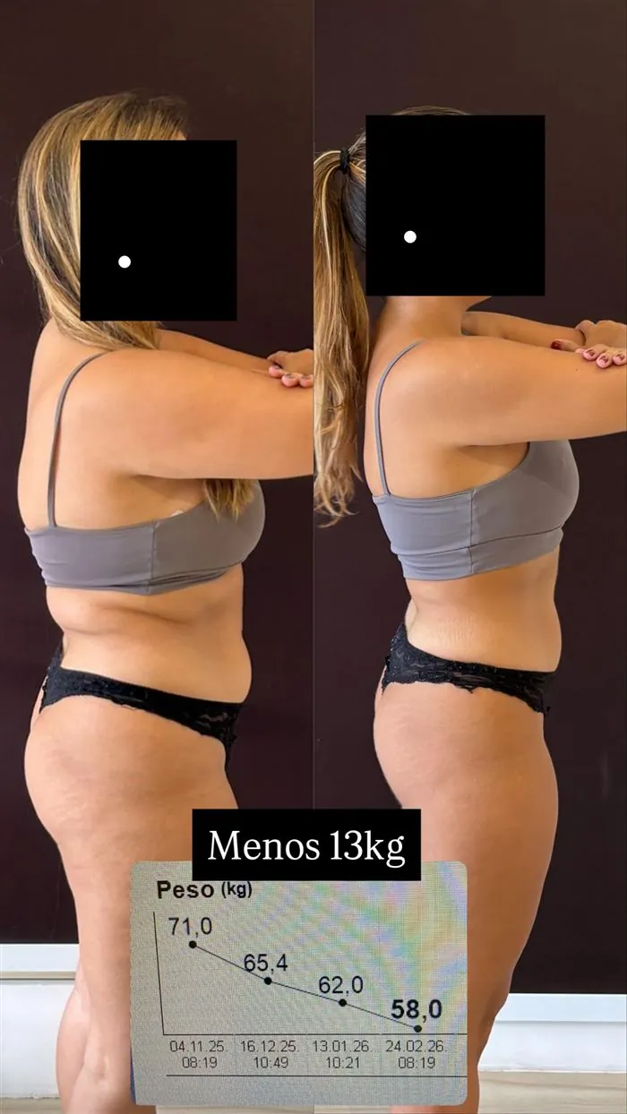 Antes e depois de paciente da Dra. Raquel, 13 kg a menos