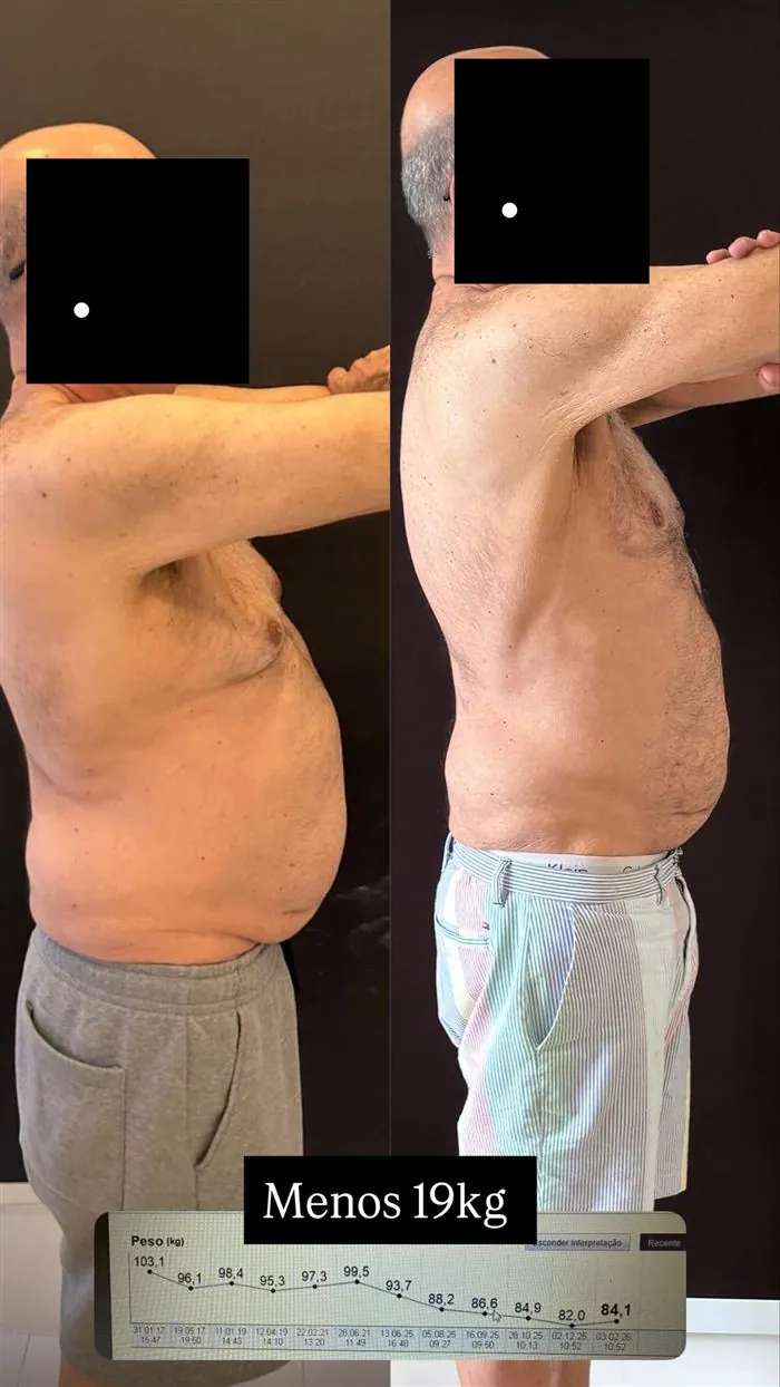 Antes e depois de paciente da Dra. Raquel, 19 kg a menos
